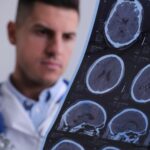 AVC mata mais de 85 mil pessoas por ano e já preocupa jovens brasileiros