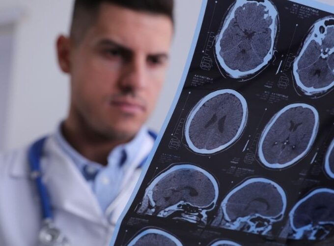 AVC mata mais de 85 mil pessoas por ano e já preocupa jovens brasileiros