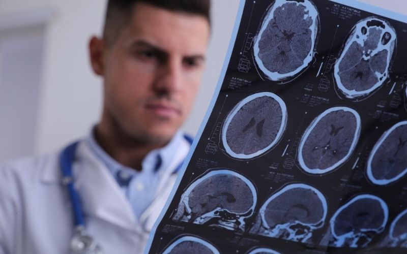 AVC mata mais de 85 mil pessoas por ano e já preocupa jovens brasileiros